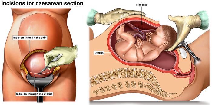Cesarean (C-section) | Pregnancy Birth and Baby