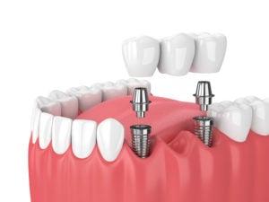 implant supported bridge NewMouth