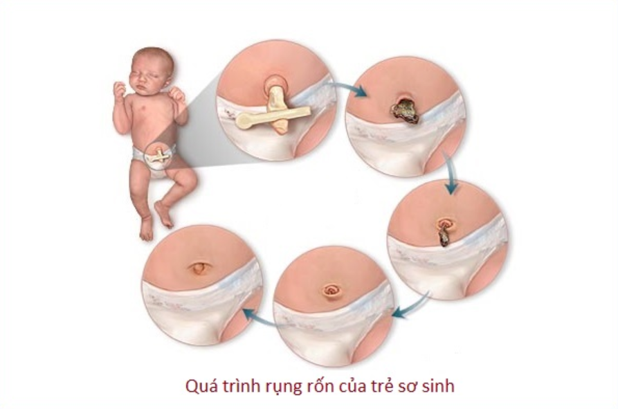 Rụng rốn