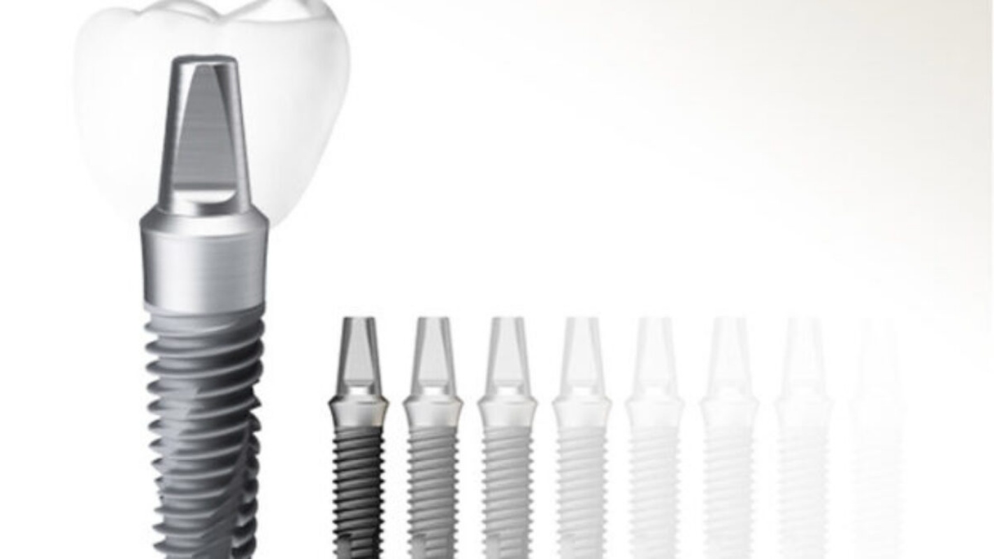 Trụ implant Mỹ Hiossen phù hợp với tất cả các vị trí trên cung hàm