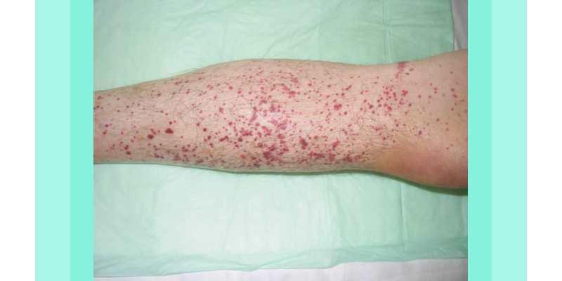 Mengenal Lebih Dalam Penyakit idiopathic thrombocytopenic ...