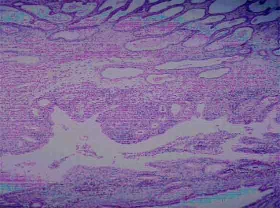 Гистологическая картина матки у суки с пиометрой. Эндометрий в значительной степени изменен и инфильтрирован нейтрофильными гранулоцитами