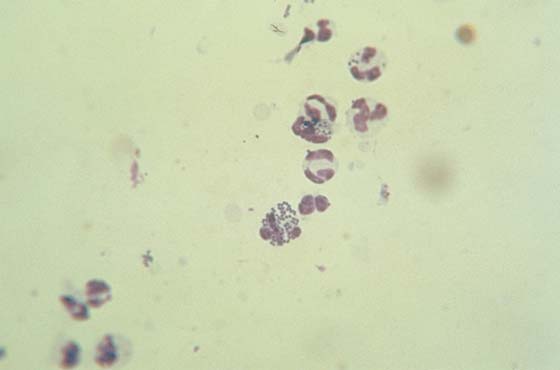 Neutrophils with intracellular cocci (arrow) pathognomonic for bacterial infection stained with DiffQuick (original magnification x1000)