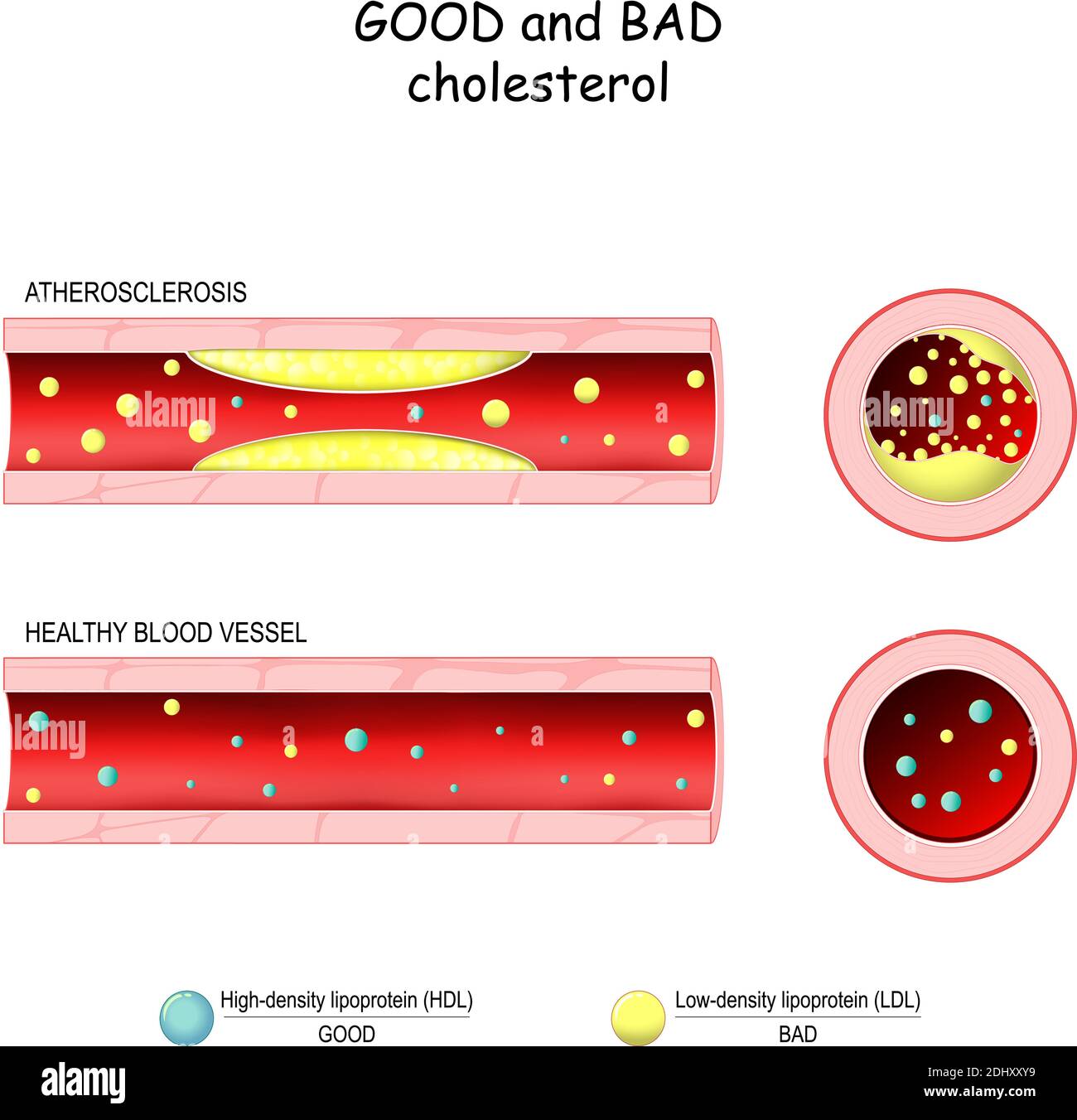 ترسب الكوليسترول الضار بالأوعية الدموية