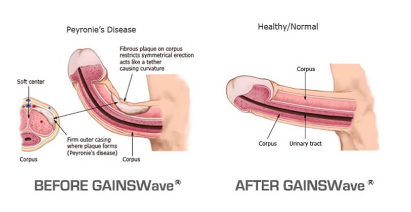 Image showing how shockwave therapy can treat Peyronie's disease and reduce the curvature of the penis - GAINSWave