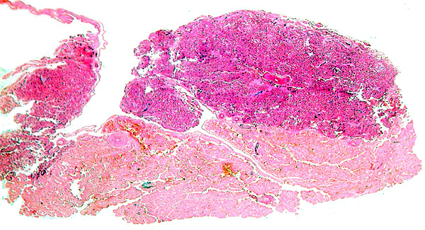 Another section with paler but histologically similar region below
