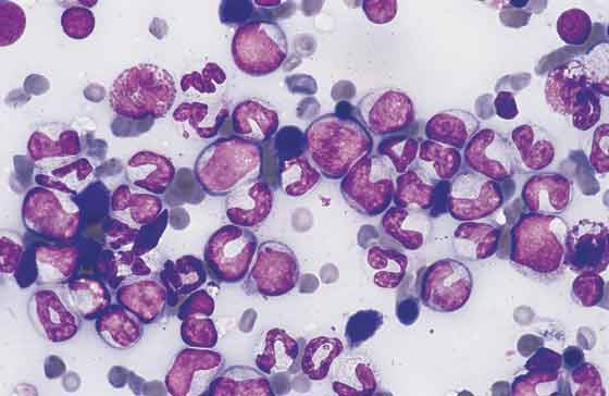 Bone marrow. Granulocytic hyperplasia and erythroid hypoplasia are evident in the marrow smear. The majority of cells are developing granulocytes with a marked reduction in erythroid activity. The CBC and marrow changes are consistent with chronic inflammation (40x).