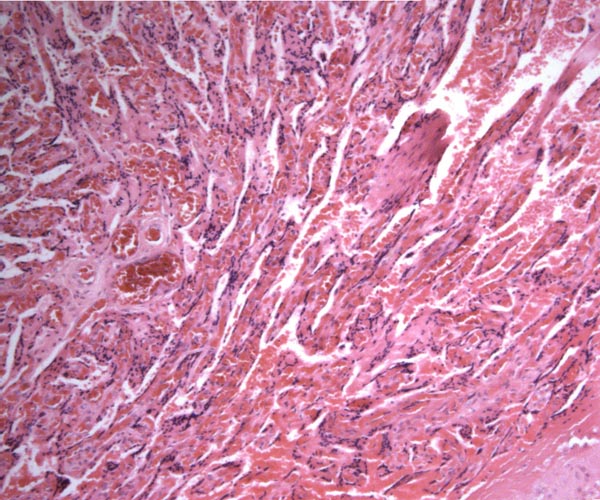 The filiform, trabecular nature of the villi is more pronounced near the placental floor (left) than higher up in the placenta (below left)