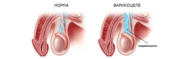 Варикоцеле
