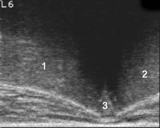 Median ultrasonographic image of the lumbosacral junction of a 5-yr-old French trotter male used for racing.
