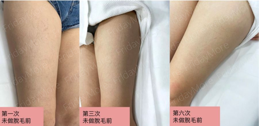 透過HAiRLESS激光脫毛，只需4至6次療程可達理想脫毛效果。