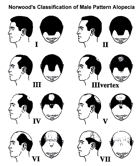 how-much-hair-transplant-do-i-need-guide