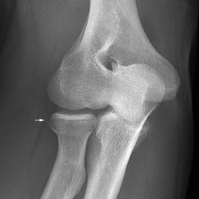 elbow xray coyles view