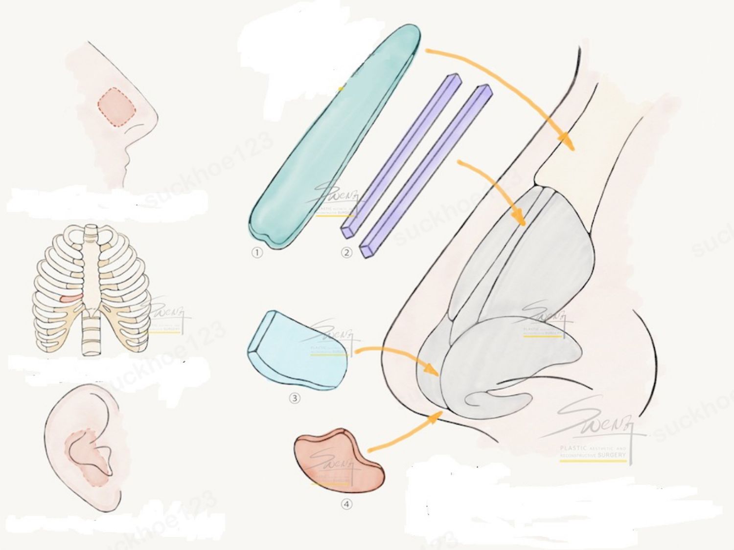 Khác với sụn nhân tạo, các loại sụn tự thân đều được lấy từ cơ thể của khách hàng nâng mũi.