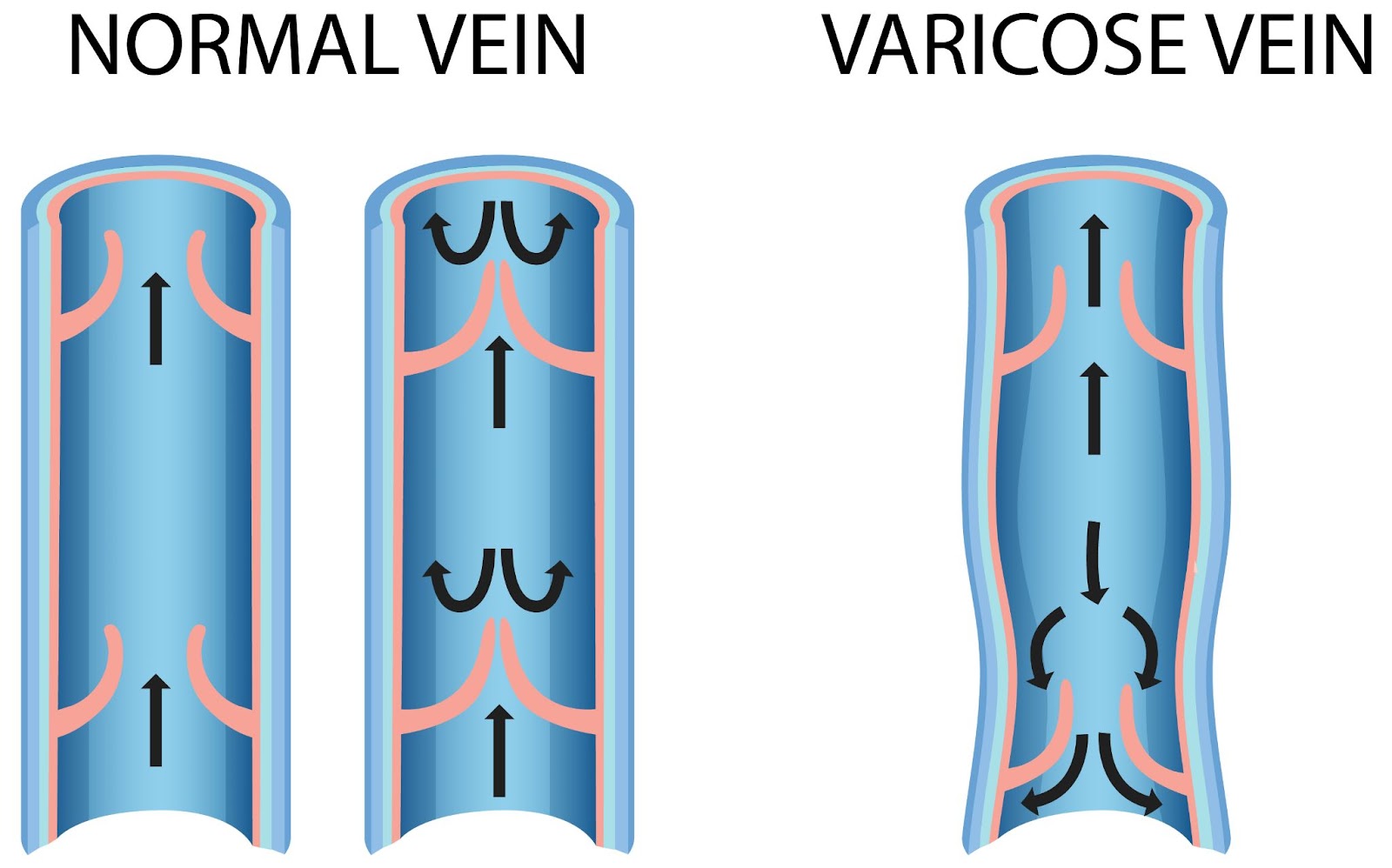 normal vein and varicose vein