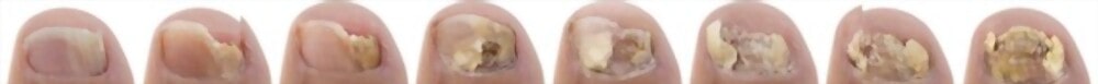 Severity level of an onychomycosis attack on the toenail