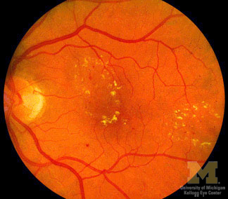 Diabetic retinopathy retina bleeding