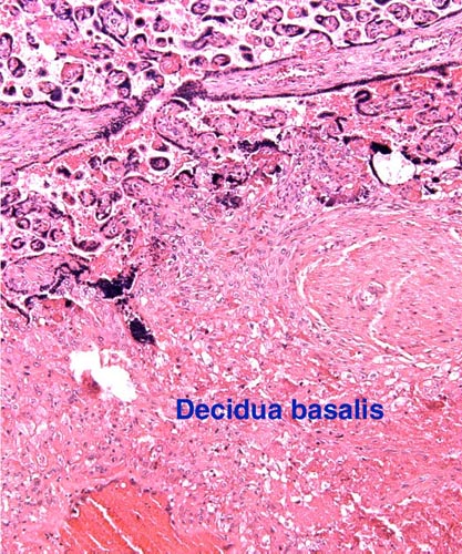 The implantation site shows anchoring fetal villi and infiltration of the decidua basalis with trophoblast. Large maternal vein at bottom