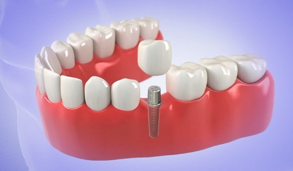 ایمپلنت دندان، جایگزینی برای دندان از دست رفته است.