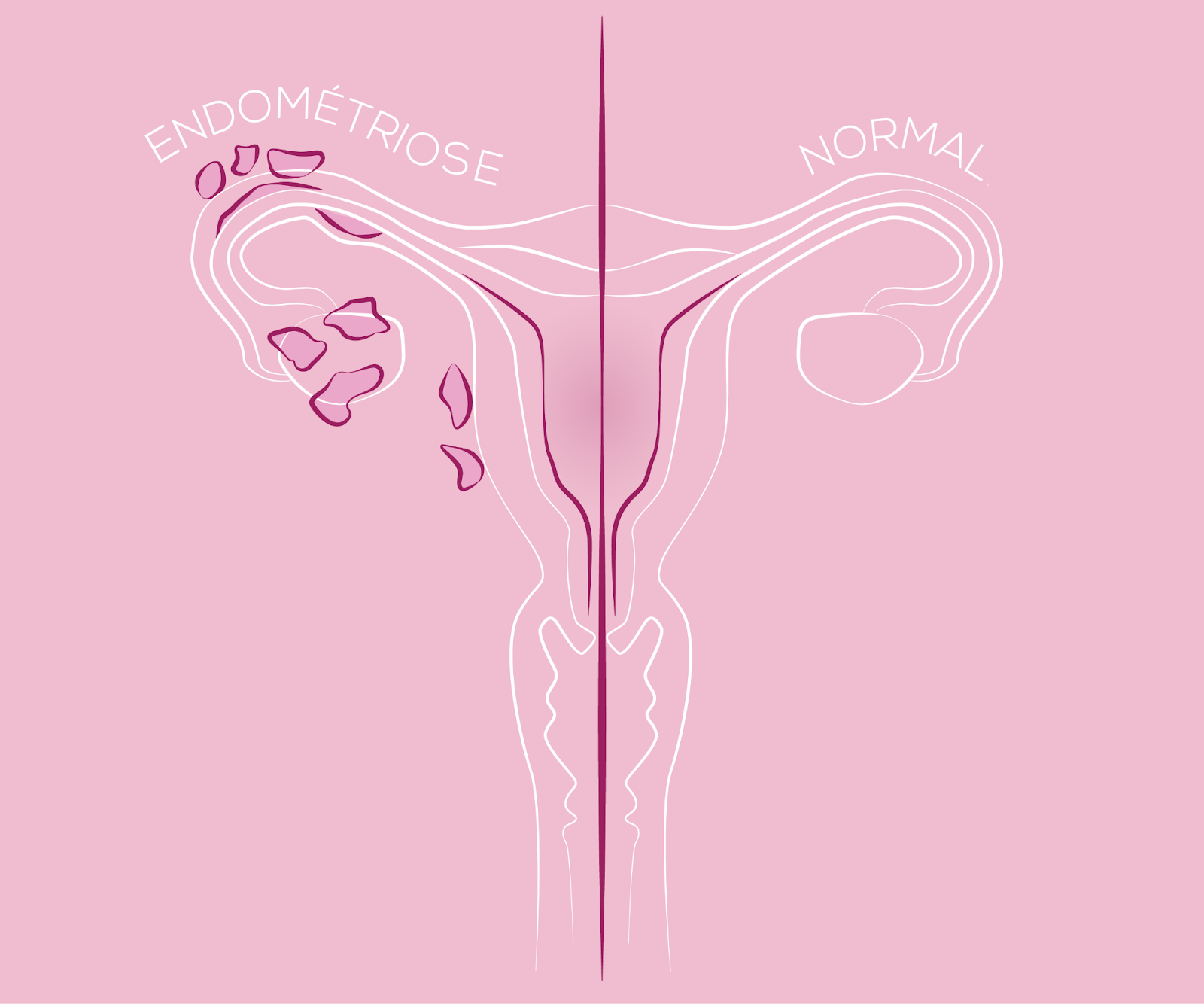 Différences entre un utérus normal et un utérus atteint d'endométriose, comparés côte à côte.