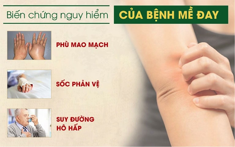 Căn bệnh mề đay mẩn ngứa tiềm ẩn nhiều nguy cơ biến chứng