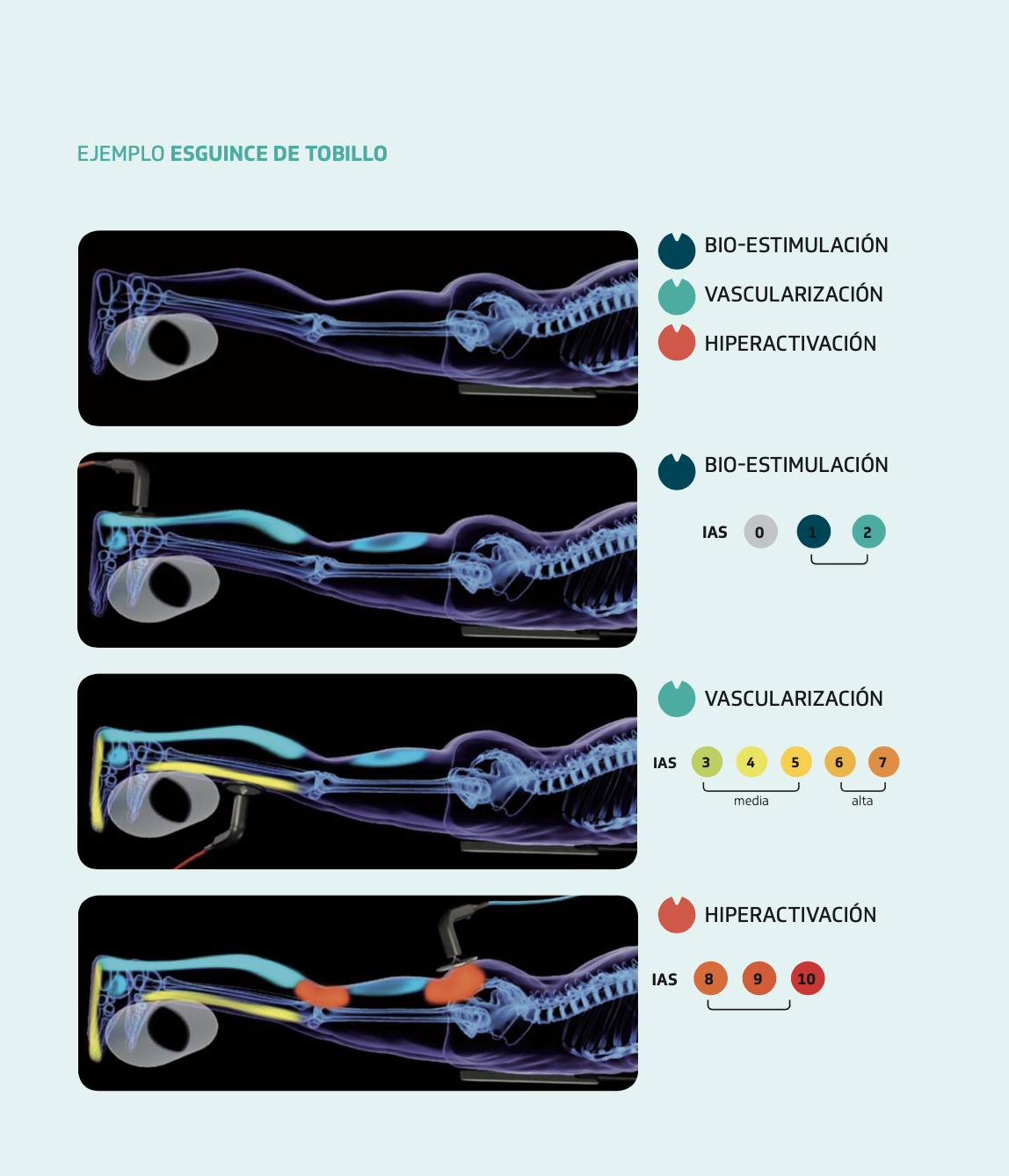 Electroterapia en fisioterapia: ¿Qué es y cómo funciona? - Material Estética