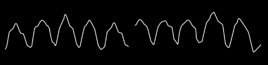 broad complex ventricular tachycardia