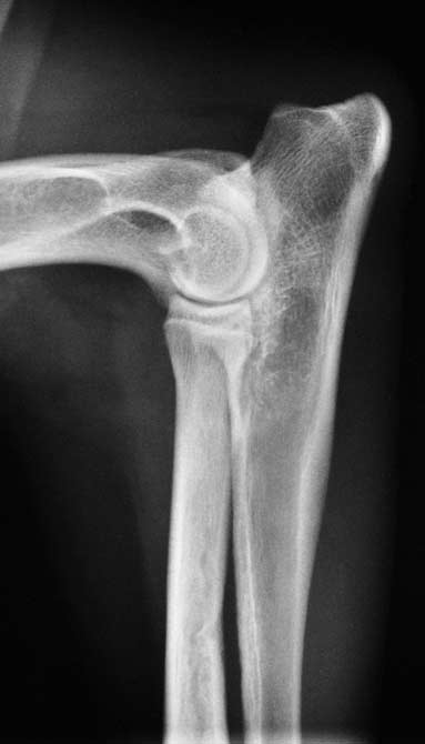 Enostosis. This 8-month-old Labrador with shifting lameness revealed pain reactions on deep palpation of the long bones including the right radius