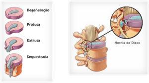 Resultado de imagem para hernia de disco em cÃ£es