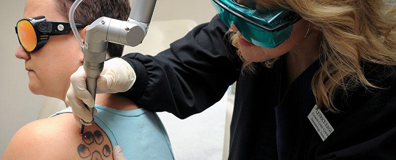 Tattoo Removal - Dermatology Associates