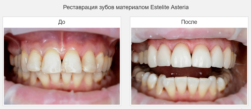 стоматолог реставрация зубов