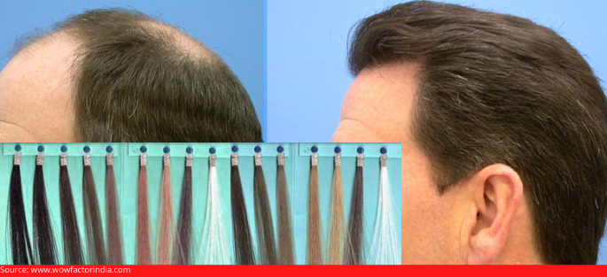 Synthetic Hair Transplant And Its Significance | Dr. Mohit Srivastava