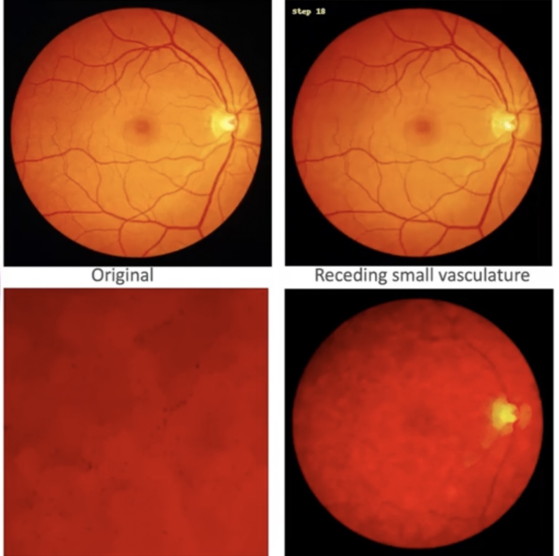 Retinal image through COLIN