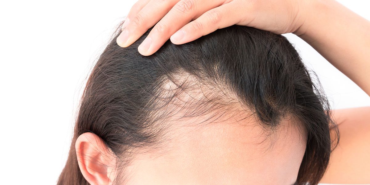 Hair Loss in Women and its treatments in Hyderabad, Hair scalp doctor near me