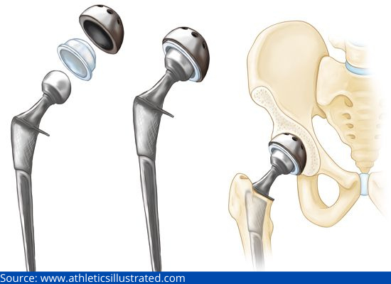 D:\Digicore\UNOSEARCH\Dr. Dilip Mehta\Arthritis and Hip Replacement Surgery\Source Surgery.jpg