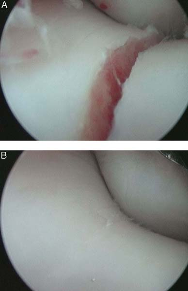 Histology 12 mo after articular cartilage defects in the medial femoral condyle were treated with microfracture and with the CCL retained (A) and removed (B).