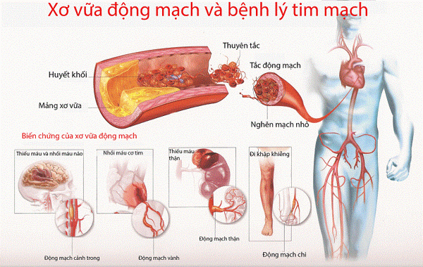 Xơ vữa động mạch là căn bệnh rất nguy hiểm cho sức khỏe của người cao tuổi. 