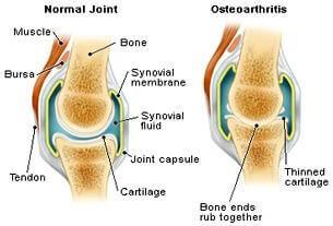 A diagram of a bone joint

Description automatically generated