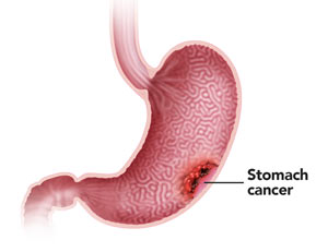stomach-Cancer
