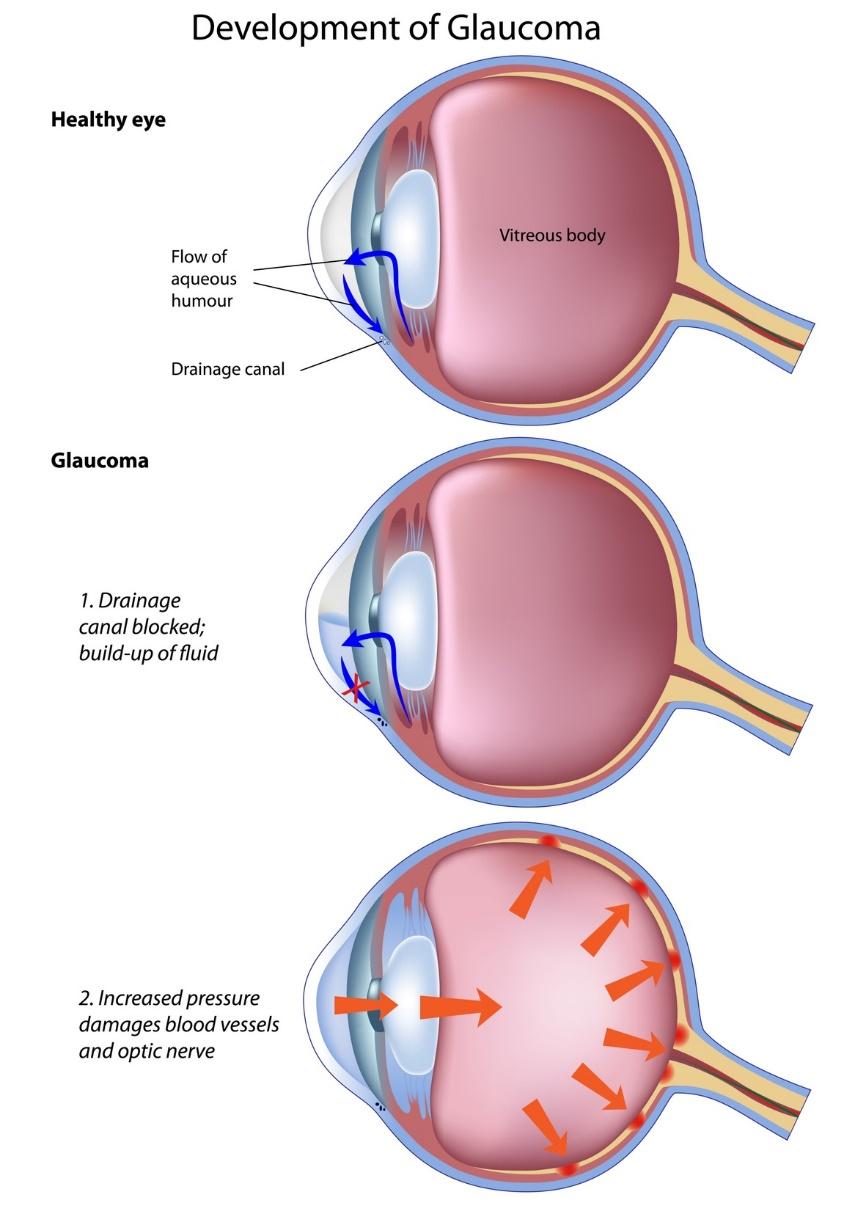 can glaucoma be treated in dogs