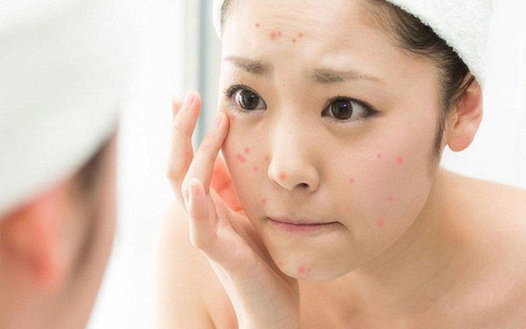 Da nổi mụn là biểu hiện do bệnh gan gây ra