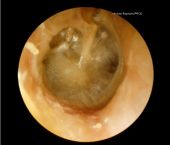 eardrum of human ear