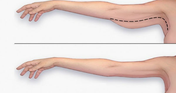Hút mỡ cánh tay là giải pháp hữu hiệu dành cho những chị em đang trong tình trạng bắp tay thô, to, mất cân đối với vóc dáng của cơ thể.