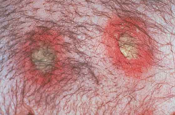 Pustule - A small circumscribed area within the epidermis filled with pus