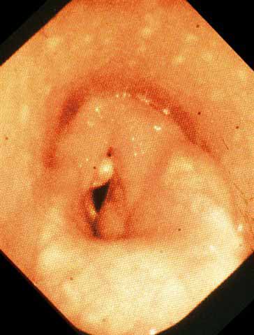 Endoscopic view of the larynx of a horse with an acute suppurative form of arytenoid chondritis. Both arytenoid cartilages are involved.