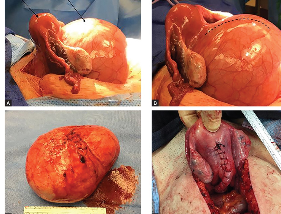 fibroid-belly-before-and-after-surgery