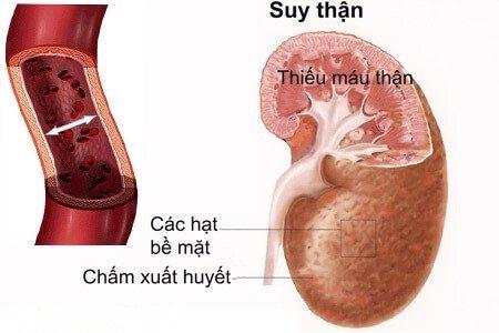 hình ảnh suy thận