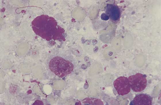 Splenic impression smear, Babesia canis. Round to oval parasites are noted within several RBCs. Round basophilic nuclear structure is noted within each protozoal organism. Disintegrated nuclei of lymphocytes are noted as round pink amorphous aggregates (100x).