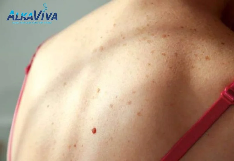 TẮM TRẮNG GÂY UNG THƯ DA VÀ NHỮNG ĐIỀU MÀ BẠN CẦN BIẾT