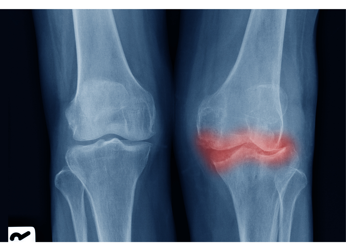 Arthritis, izületi gyulladás legyőzése - szelíden